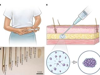 thumbnail - Contraceptive Implant